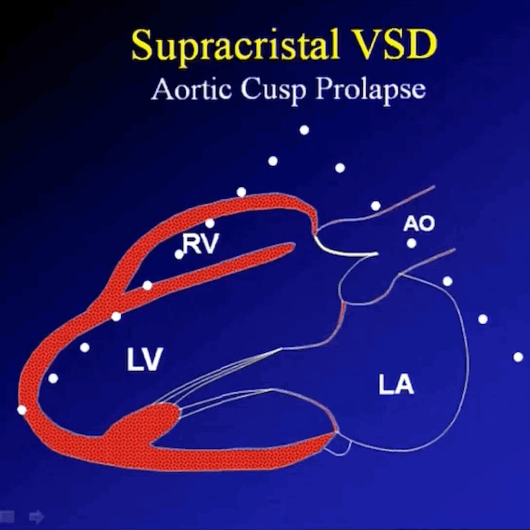 ritu-thamman-md-on-twitter-subpulmonic-vsd-or-supracristal-vsd-can-be