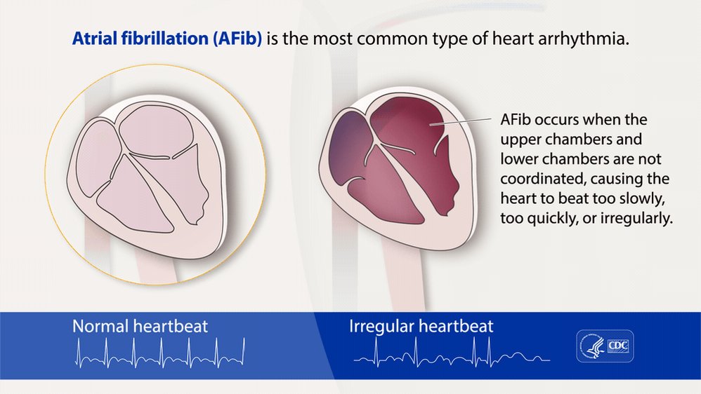 CDC Division for Heart Disease & Stroke Prevention on Twitter "Atrial