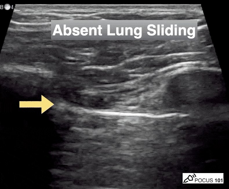 Abdominal Ultrasound Made Easy: Step-By-Step Guide - POCUS 101