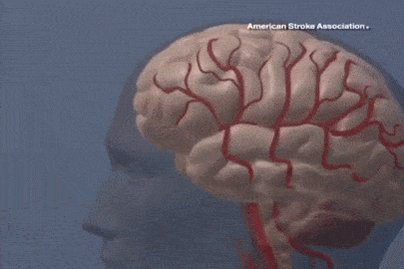 Gif animado mostra um AVC com um coágulo sendo formado num 