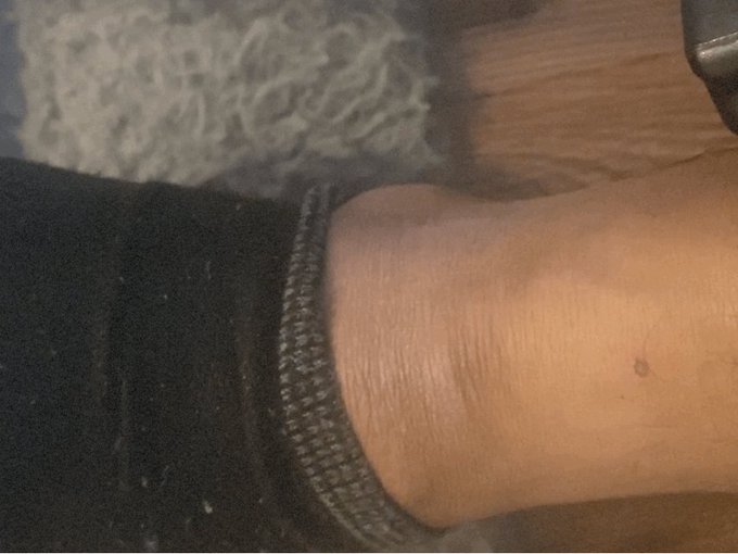 On blood thinner medication we see that leather ah cut chu. In a life threatening emergency it&rsquo;s still<a href="/tag/slr"class="tags"><span>#slr</span></a>