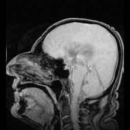 CSF removing brain toxins which are suspected to cause neuro