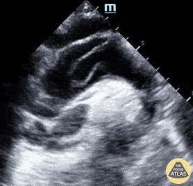 Suprasternal aortic view #POCUS #anatomy
- used in the evaluation of aortic aneurysms, dissection, c...
