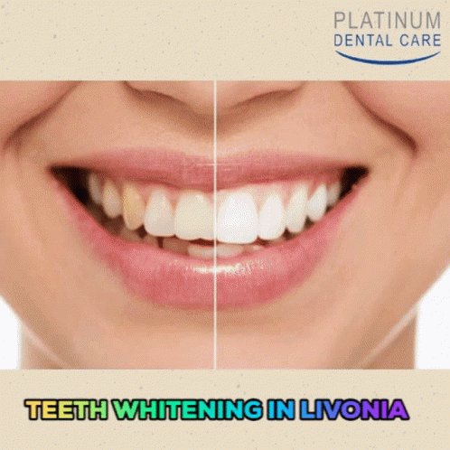 Lumineers In Livonia Lumineers Dental GIF