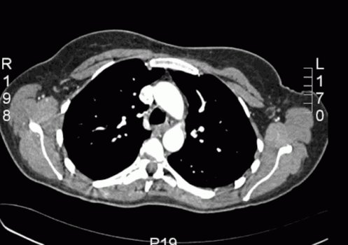 Abdominal Ct Scan GIF