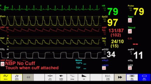 Hospital Monitor GIF