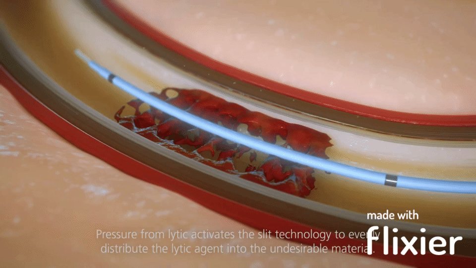 Unifuse Catheter by AngioDynamics https://www.youtube.com/wa