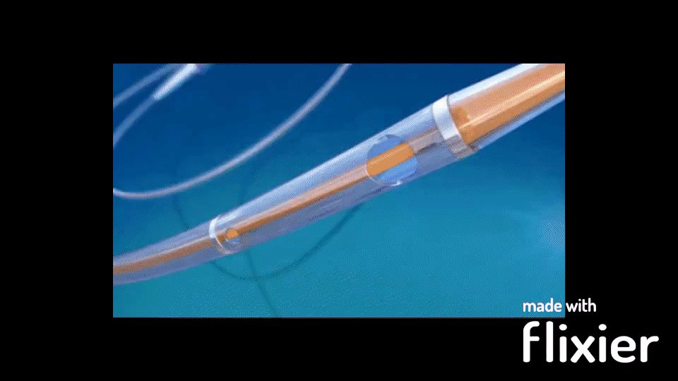 Boston Scientific Rheolytic catheter https://www.youtube.com