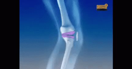 Knee Arthritis GIF